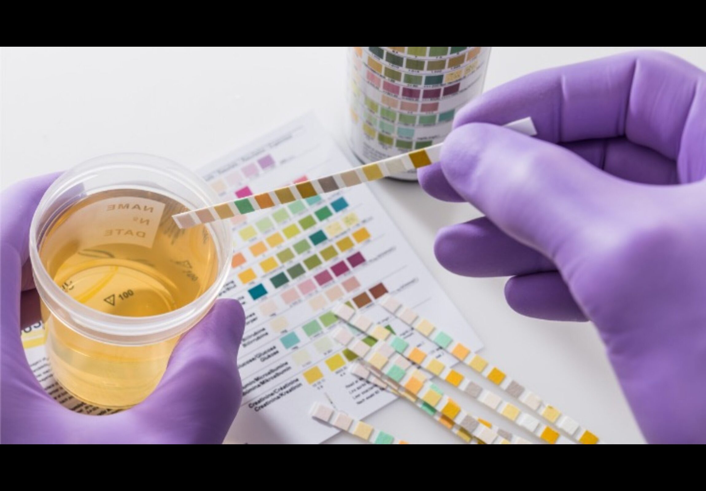 Read more about the article Blasenkrebs finden und nachsorgen – ein neuer Test verringert die Anzahl an notwendigen Blasenspiegelungen